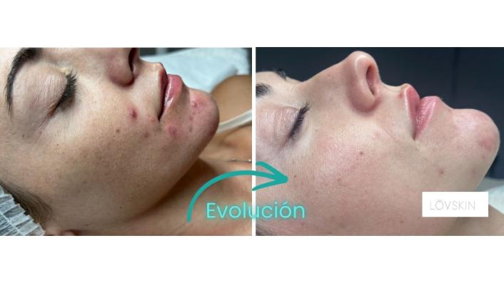 Microneedling para marcas de acné. Evolución